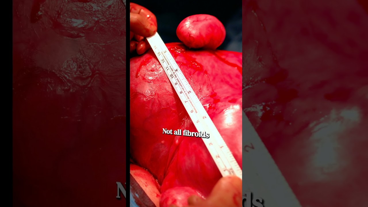 Can Fibroids Disappear Naturally? 🤔
