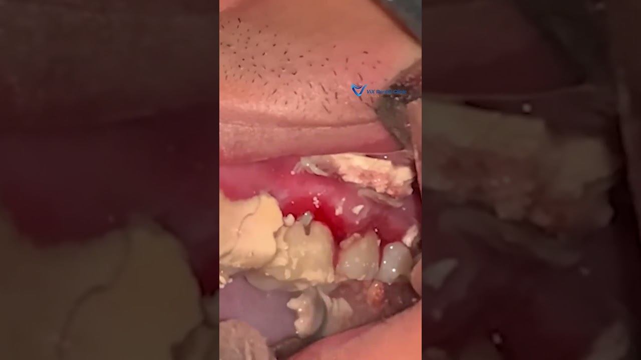 Cạo vôi răng sớm để phòng viêm nướu 🦷