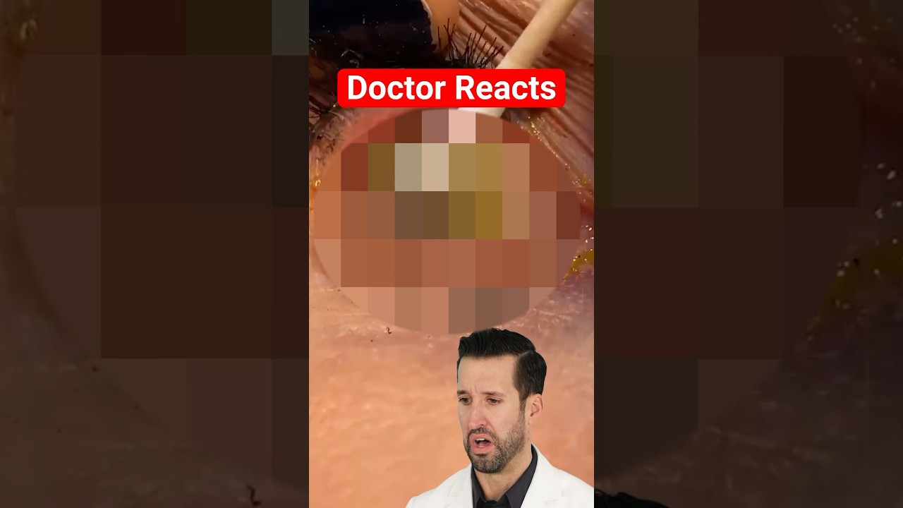 ER Doctor Reacts to Satisfying Contact Lens Removal 👁️