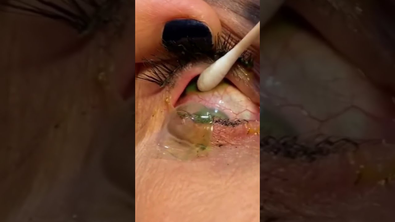23 Contact Lenses Stuck in Eye: How They Were Removed