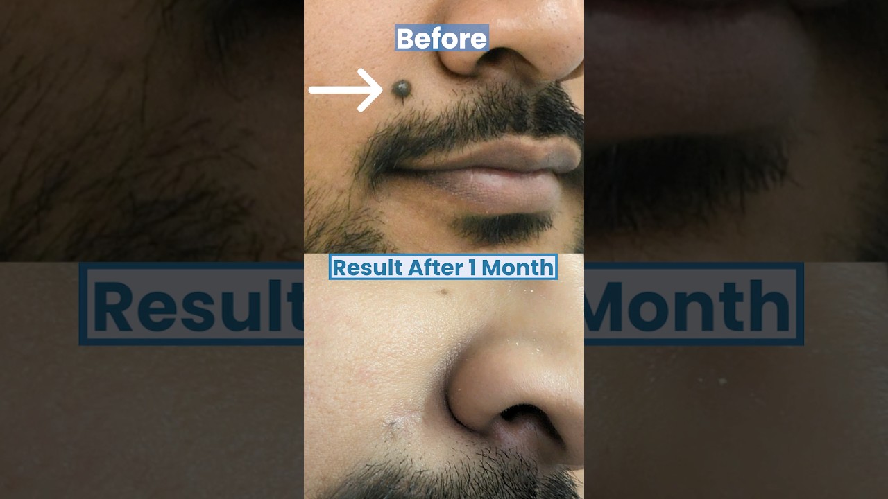 Mole Removal Results: 1-Month Transformation ✨