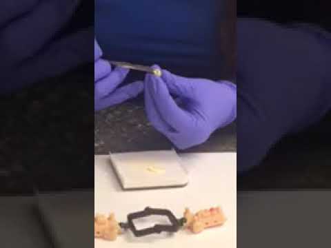 Re-cement a Temporary Crown Easily 🦷