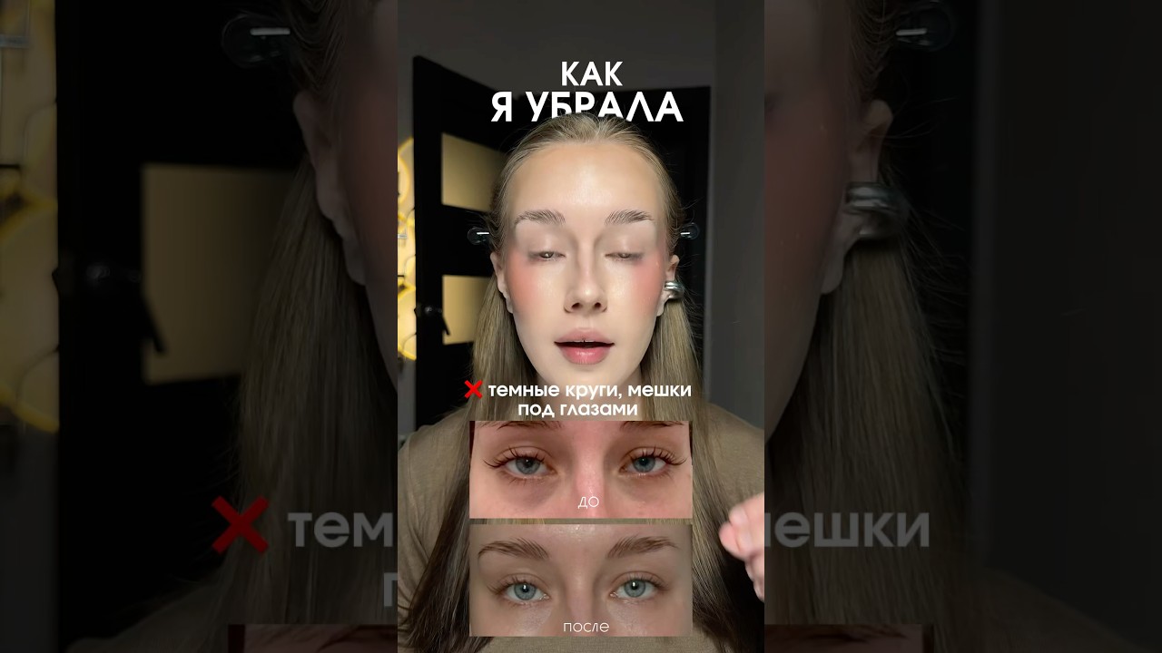 Как избавиться от темных кругов и мешков под глазами ✨