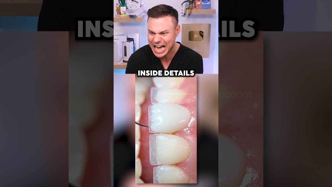 Dentist Shows True Look of Professional Veneers 😁