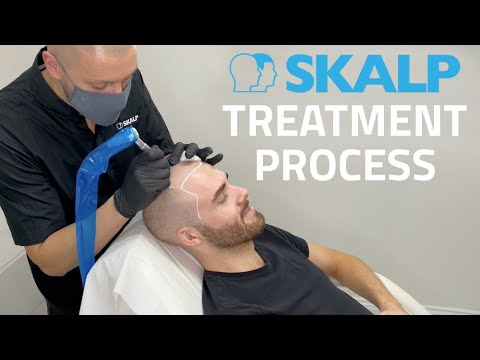 Skalp® Scalp Micropigmentation: Full Treatment Process