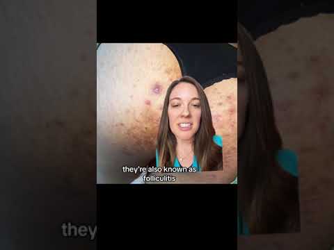 Butt Acne? Causes & Treatment Tips 🚿