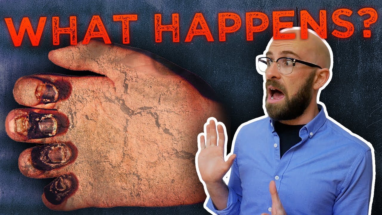 Does Leprosy Cause Fingers & Toes to Drop Off? 🦠