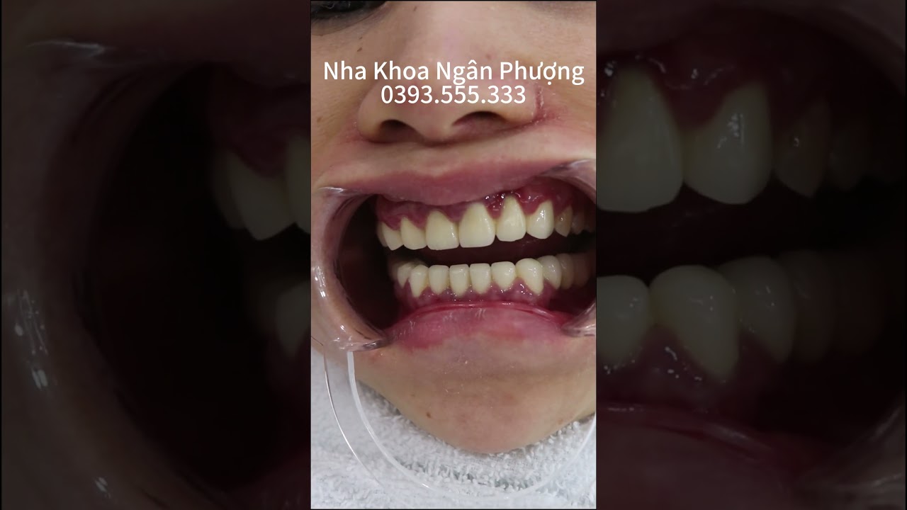 Răng Sứ Bị Viêm Lợi: Nguyên Nhân & Cách Khắc Phục