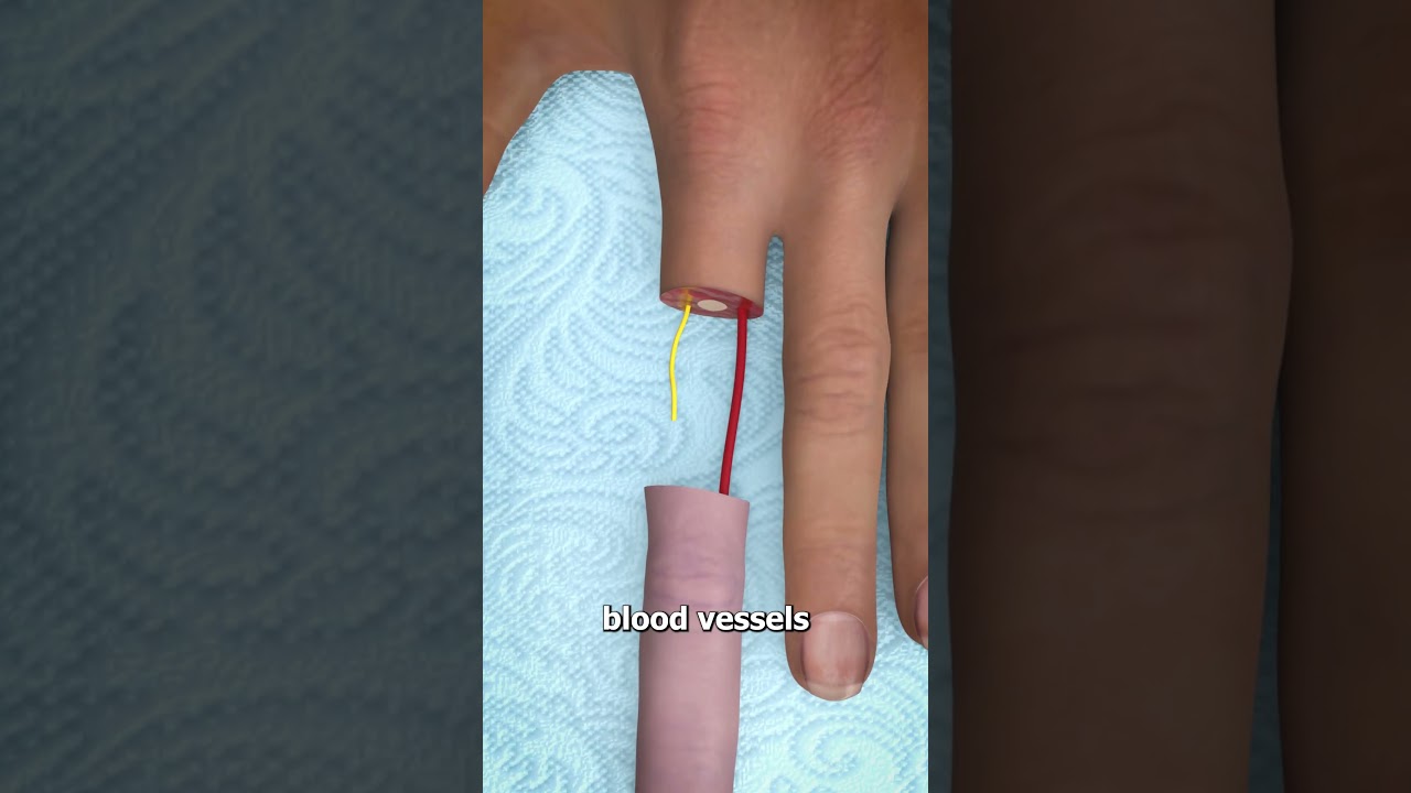Can You Reattach a Severed Finger? ποΈ