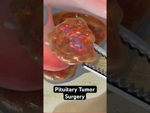 Pituitary Tumor Surgery (3D Animation)