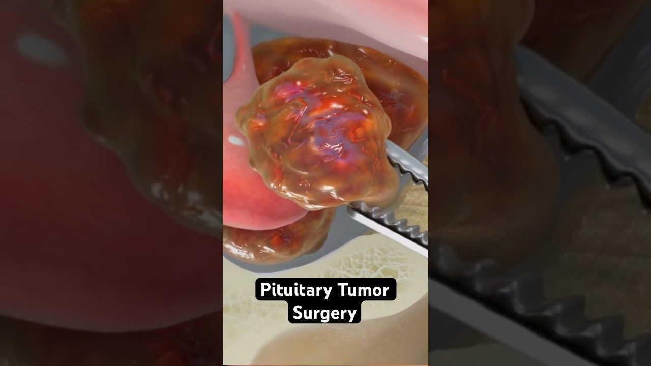 Pituitary Tumor Surgery Explained: 3D Animation of Transsphenoidal Approach 🧠