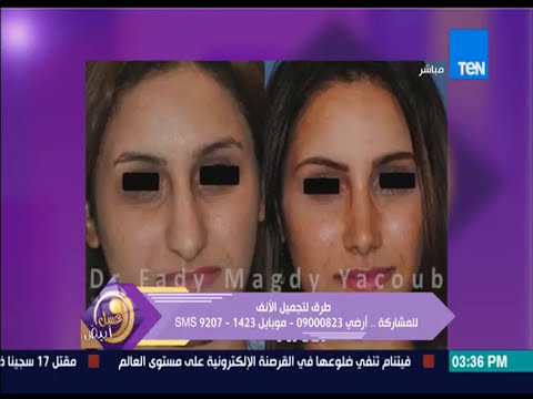 د. فادي مجدي يعقوب يتحدث عن عمليات التجميل على TEN TV
