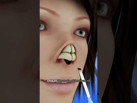 Transform Your Nose with Rhinoplasty #shorts - Creativelearning3d