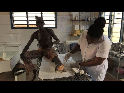 Oladele's Fight Against Leprosy Despite Misconceptions ✂️