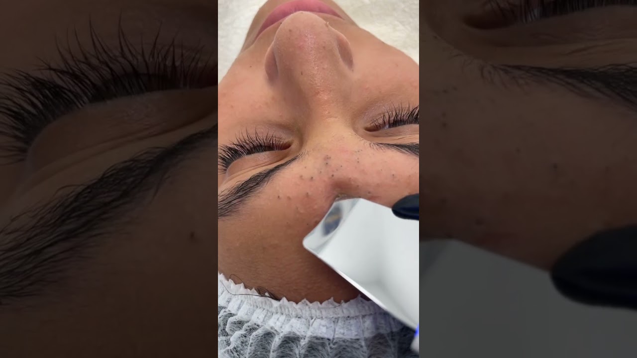 Satisfying pimple popping #satisfying #blackheads #pimple #pimples #doctor #skincare #short #shorts