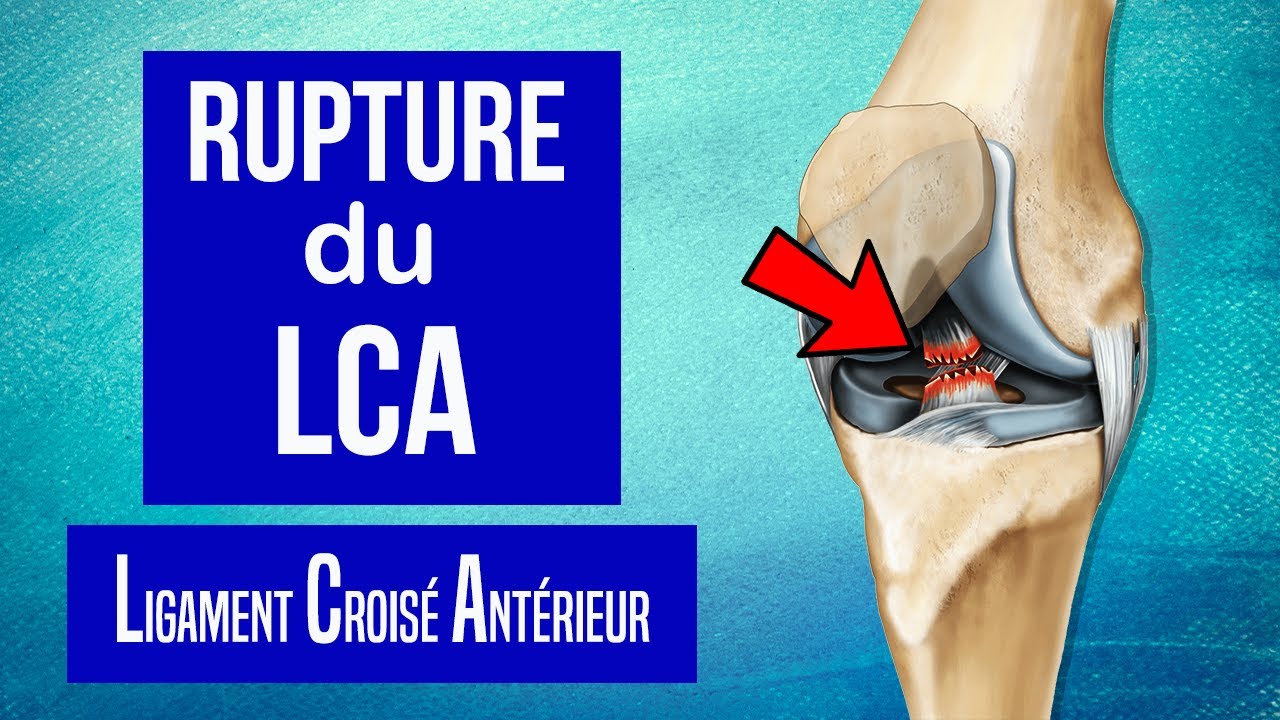 Traitements pour la Rupture du LCA du Genou 🦵