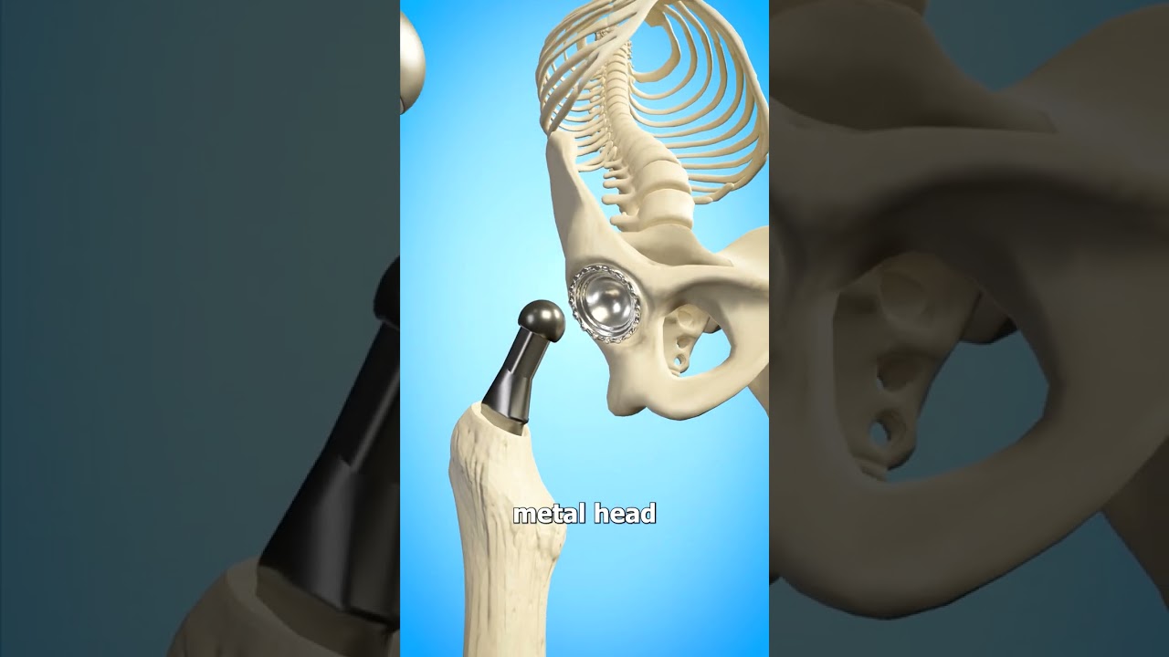 Total Hip Replacement Explained: What You Need to Know 🦴