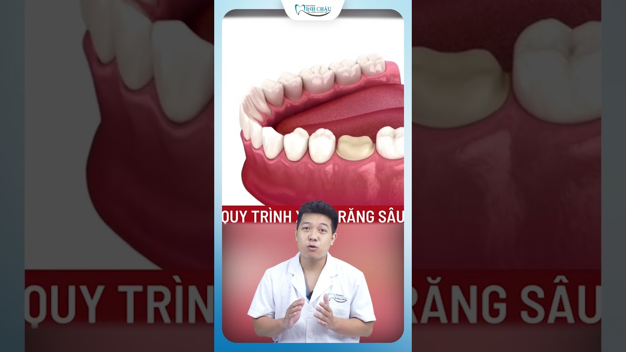 Cứu Răng Sâu Khổng Lồ tại Nha Khoa Minh Châu