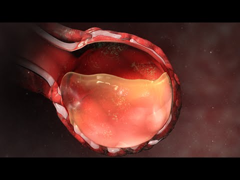 Pneumonia Overview and Licensing Info
