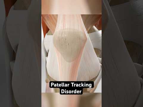 Reducing knee pain caused by misalignment (3D Animation)