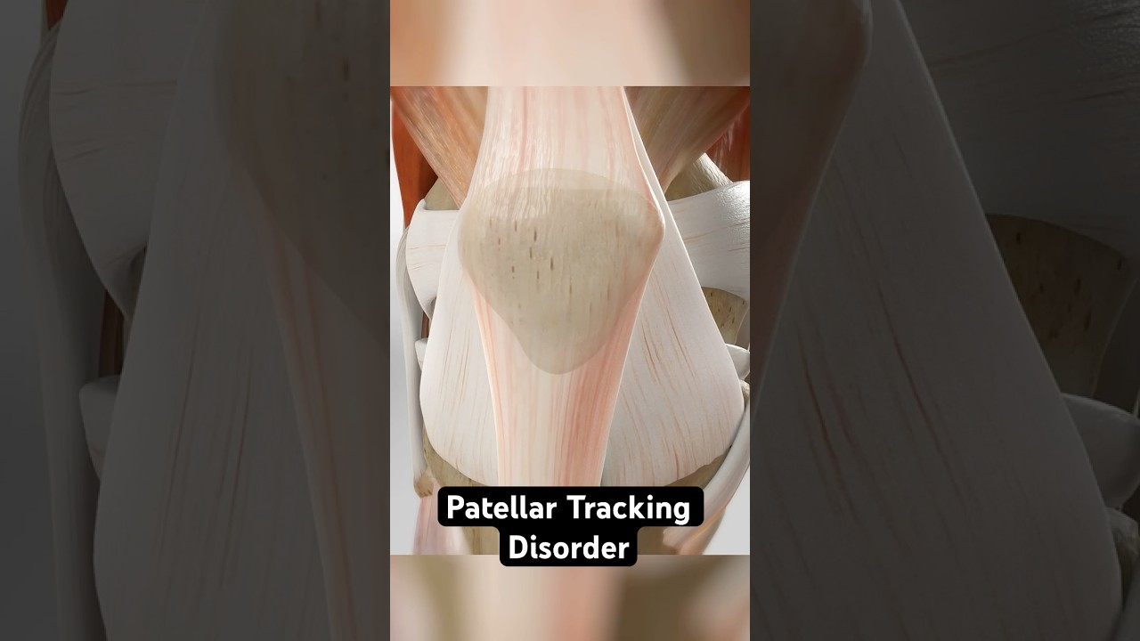 Reducing Knee Pain from Misalignment Using Lateral Release and Medial Imbrication Techniques (3D Animation)