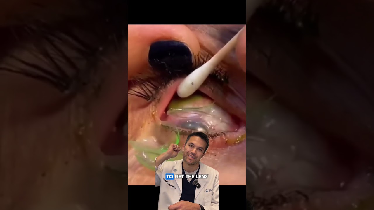 Woman Finds 23 Contact Lenses Stuck Under Eyelids 👁️