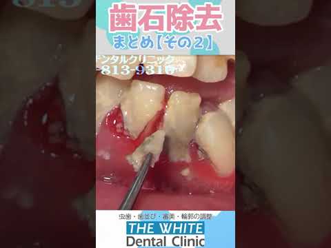 牡蠣化した歯石🦷【名場面集その2】Oyster-like tartar Collection of famous scenes 2#Shorts