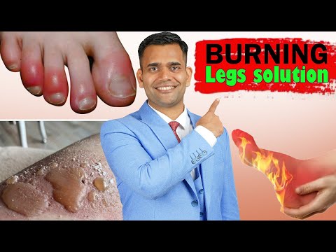 🔥Burning Legs And Burning Feet Treatment and Herbs That Can Help🔥