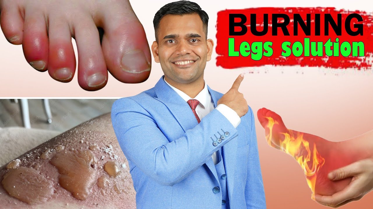 Effective Treatments & Herbs to Relieve Burning Legs & Feet ๐ฅ