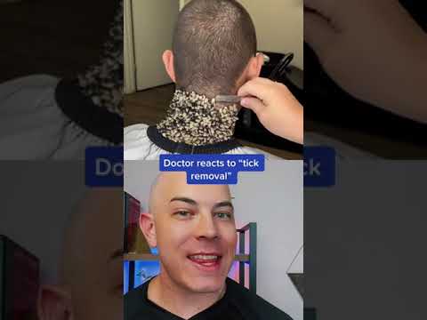 Are Tick Removals Fake or Real? 🕷️