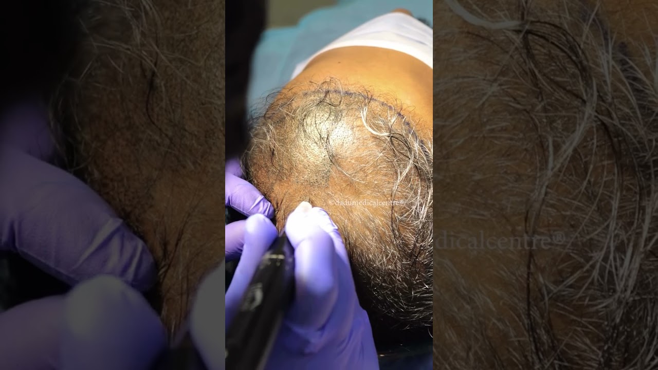 Scalp Micropigmentation: Non-Surgical Hair Solution