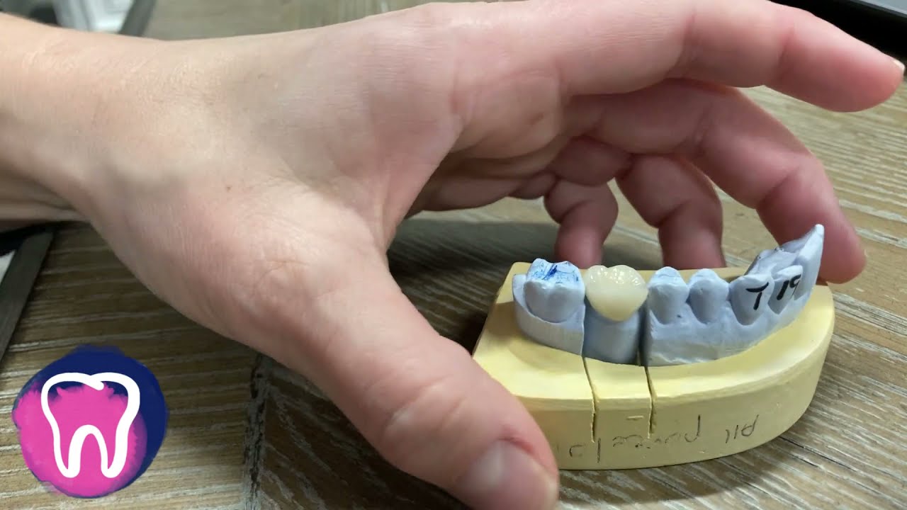 Recement a Loose Dental Crown at Home 🦷