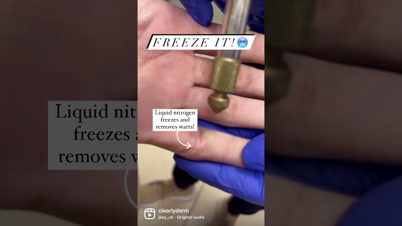 Freeze Your Wart Away❄️