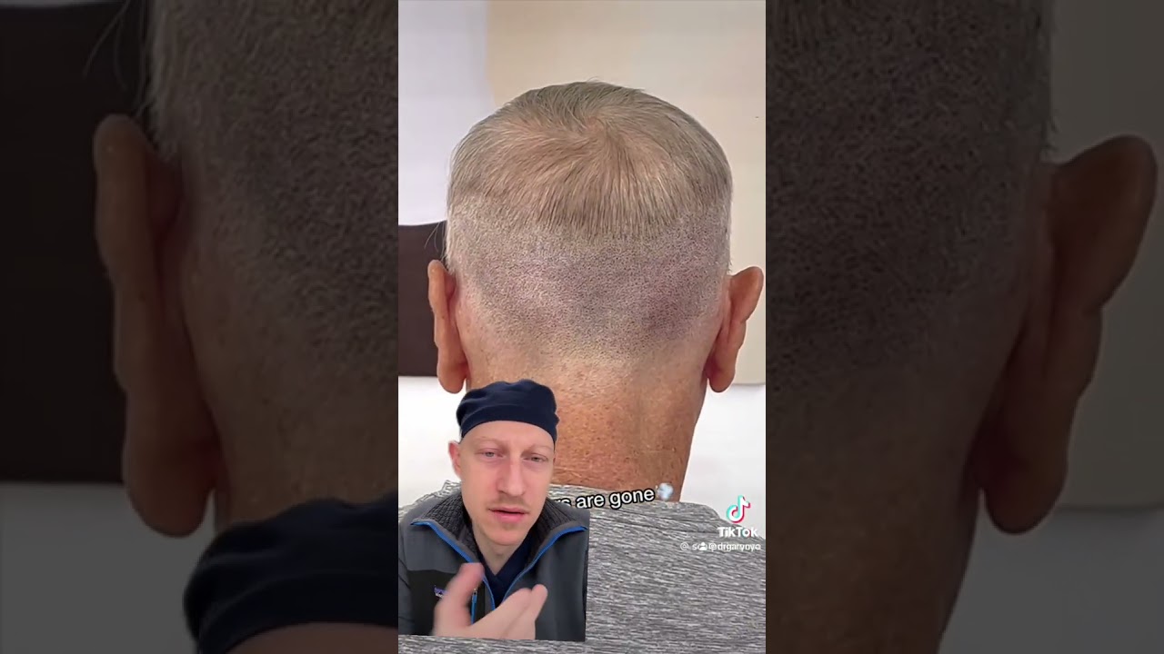 Hair Transplant Scars Fixed with Scalp Micropigmentation 💇‍♂️