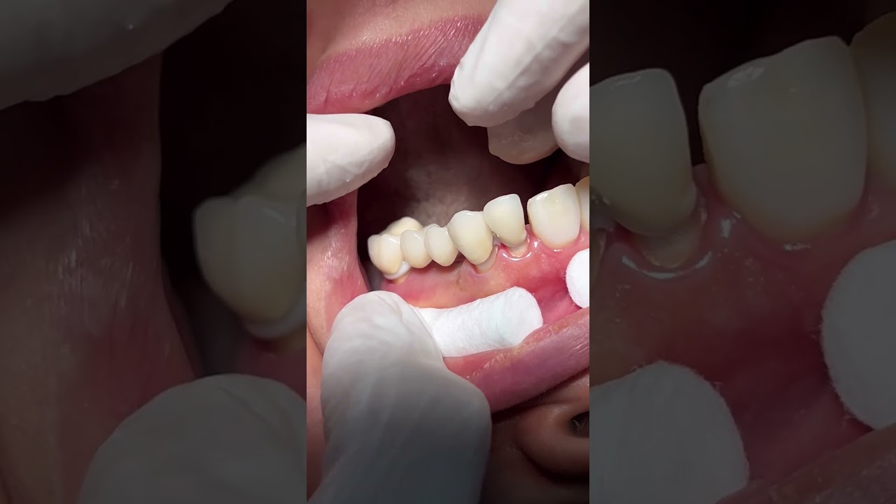 Dental Bridge Repair & Care 🦷