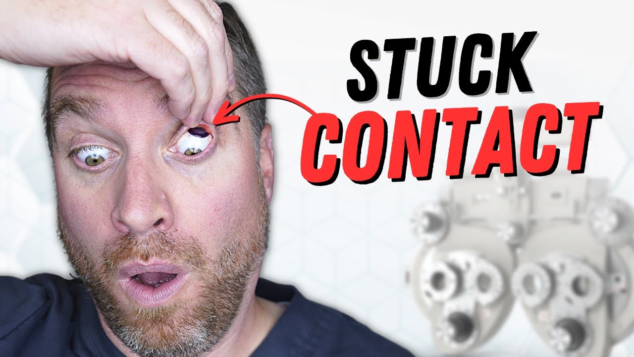 How to Remove a Stuck Contact Lens from Upper Eyelid