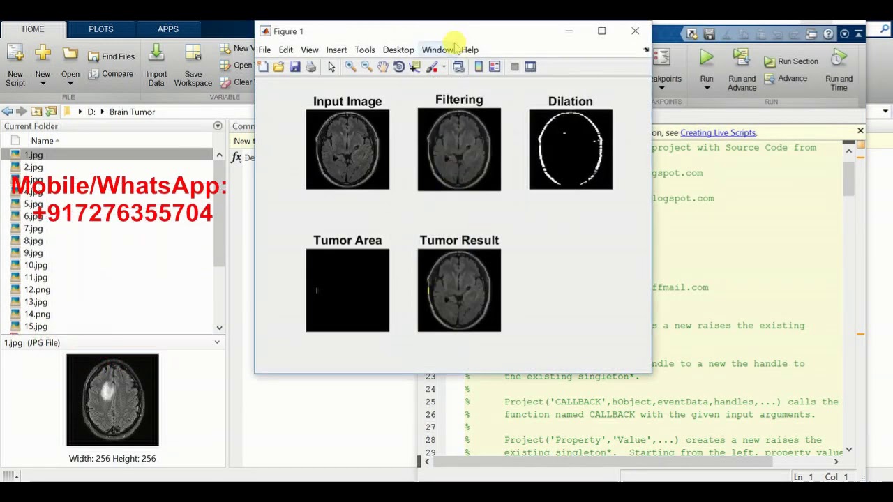 Brain Tumor Detection Using Image Processing Matlab Project Source Code