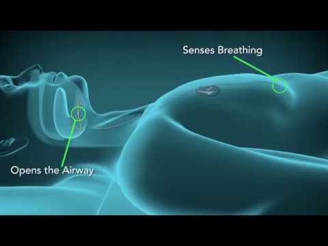 Inspire Therapy: Innovative Sleep Apnea Treatment 💤