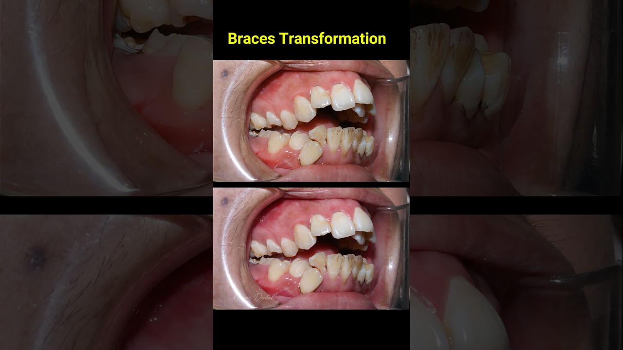 3-Year Braces Transformation 🦷