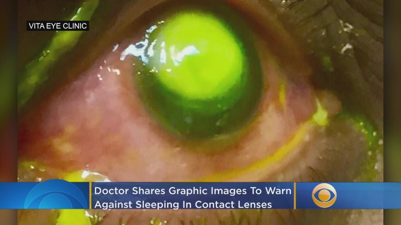 Doctor Warns Against Sleeping in Contact Lenses 🚫