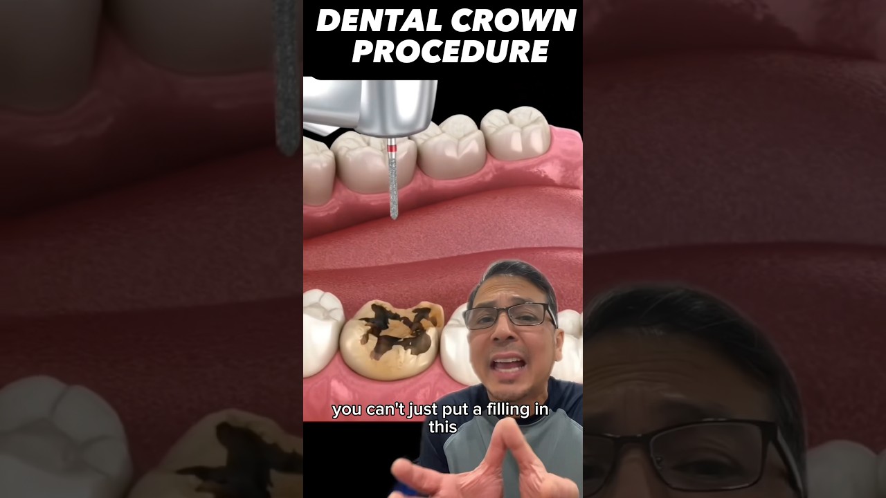 Restoring Worn Teeth with Dental Crowns 🦷
