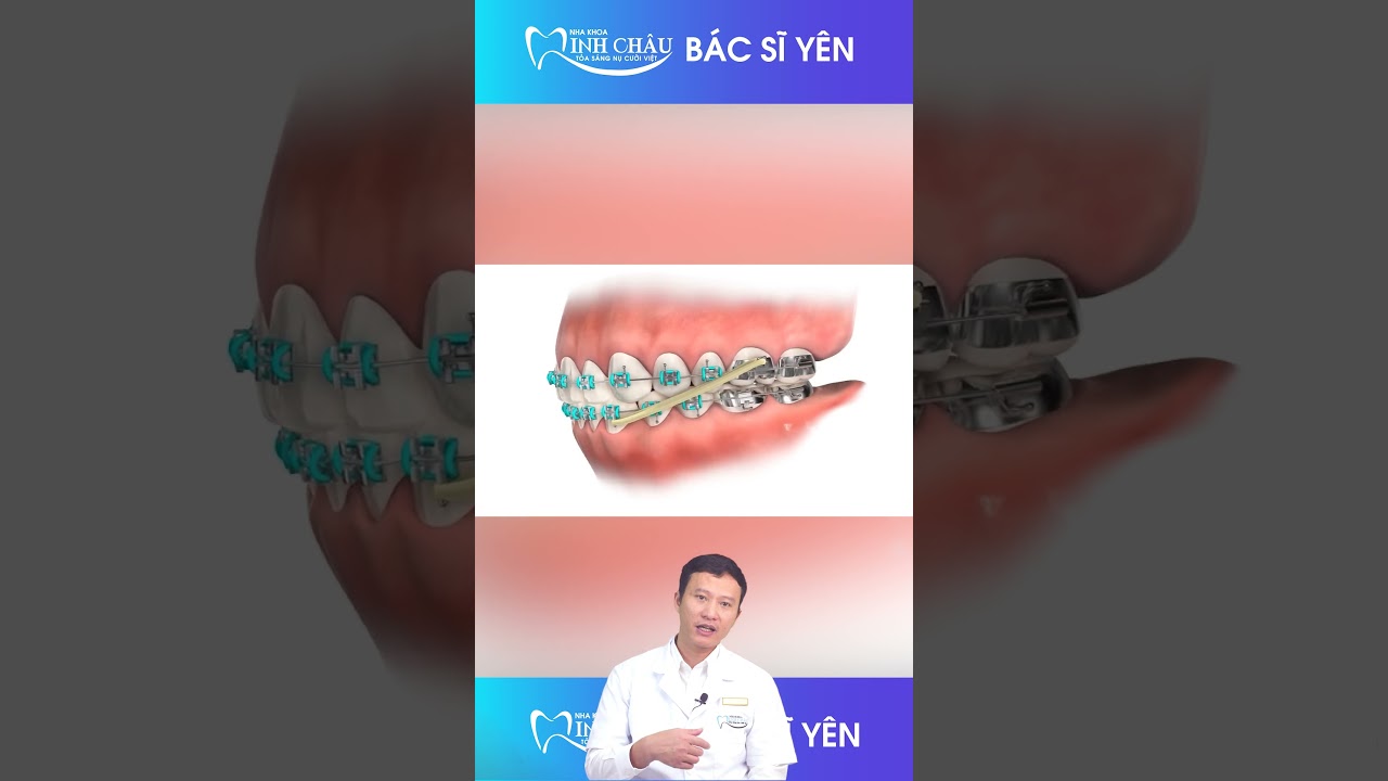 Niềng Răng Hô Hàm Trên? | Nha Khoa Minh Châu