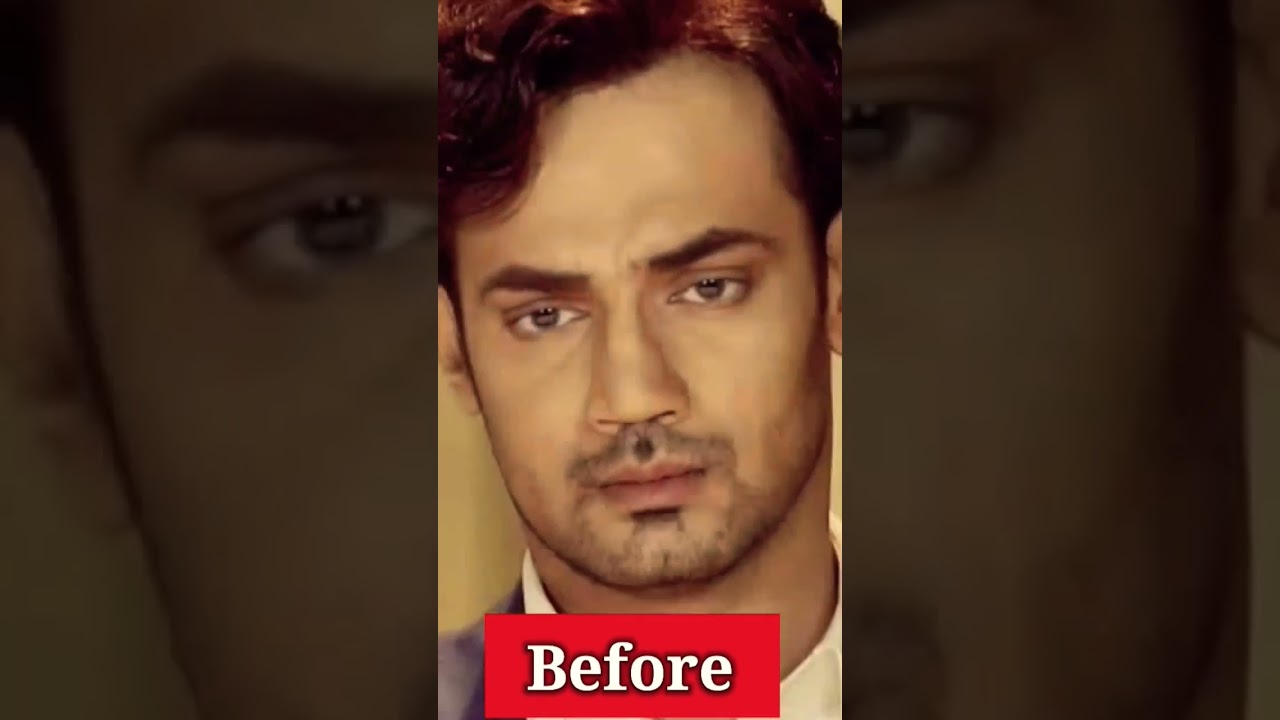 Zahid Ahmed Surgery Transformation Short | P Montage