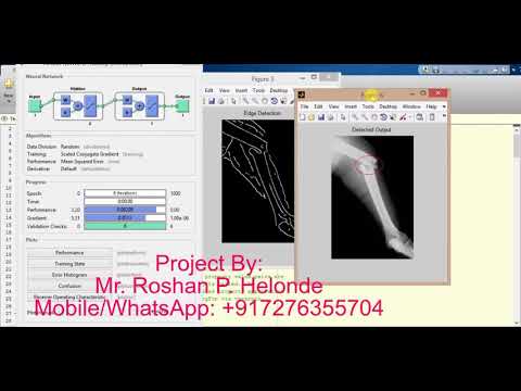 Bone Fracture Detection using neural network matlab project source code