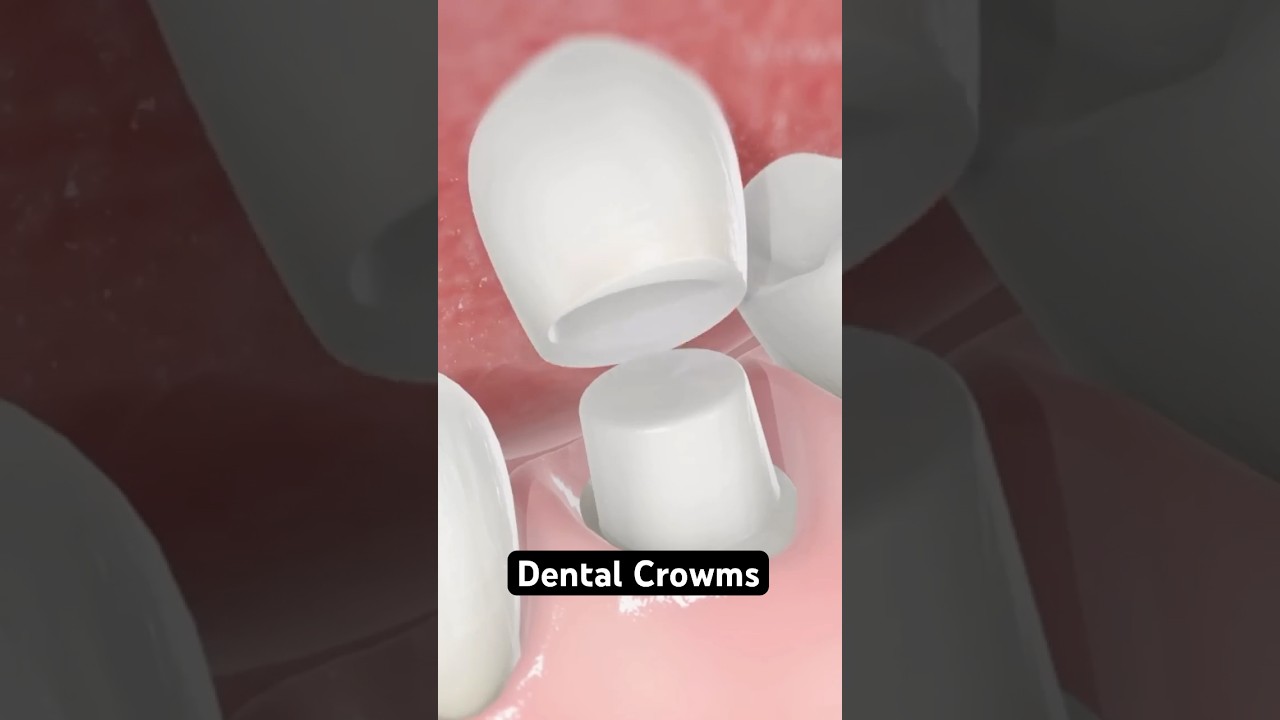 Dental Crowns Explained with 3D Animation 🦷