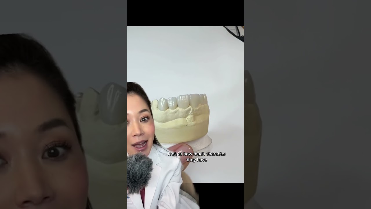 How long does it take the gums to heal after the veneer process? #veneers #smilemakeover #gumhealth