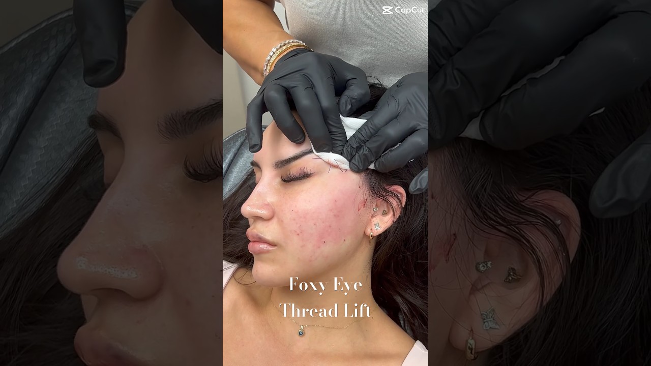 Foxy Eye Thread Lift by Dr. Gideon Kwok at Skin Perfect Rancho