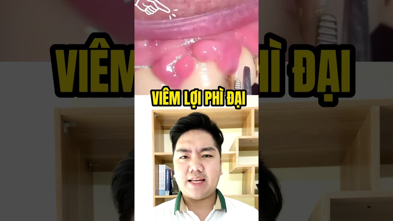 Viêm Lợi Phì Đại: Triệu Chứng & Điều Trị 🦷