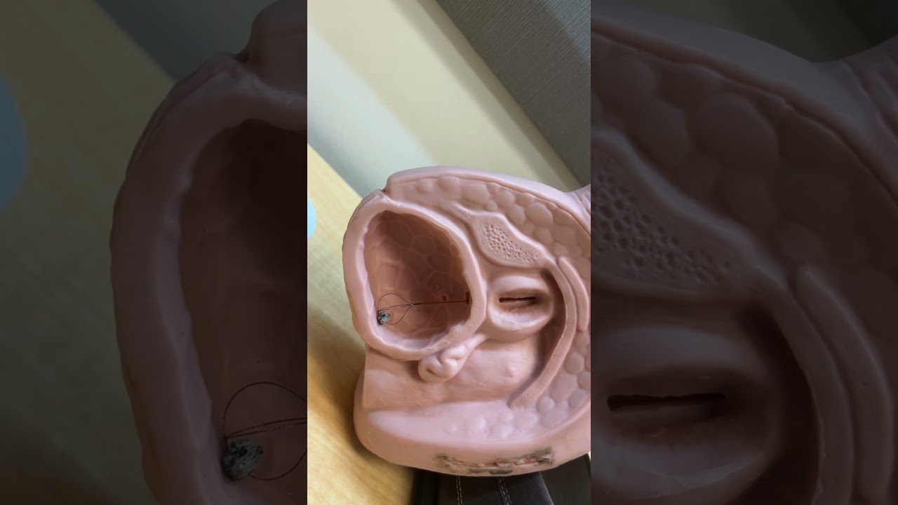 Bladder Stone Removal with Flexible Grasper 🩺