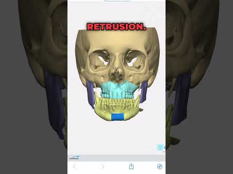 How to correct an asymmetric face through orthognathic surgery.